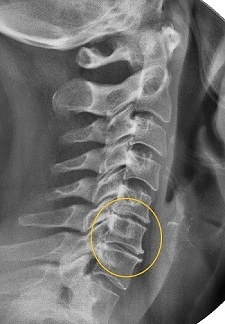 Narrowing of the intervertebral space on X-ray examination