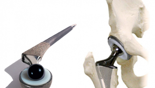 arthroplasty of the hip joint for osteoarthritis