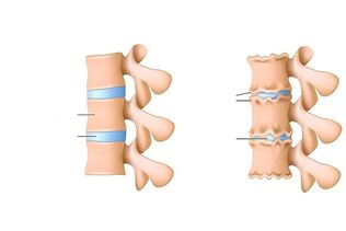 Osteochondritis of the spine