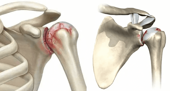 what does osteoarthritis of the shoulder joint look like