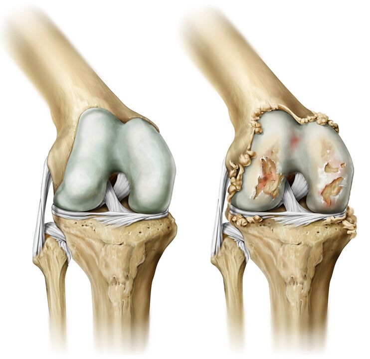 what does osteoarthritis look like