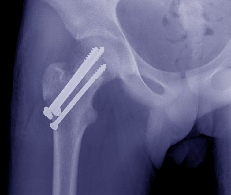 X-ray of the hip joint, osteosynthesis of the fracture with internal fixation devices