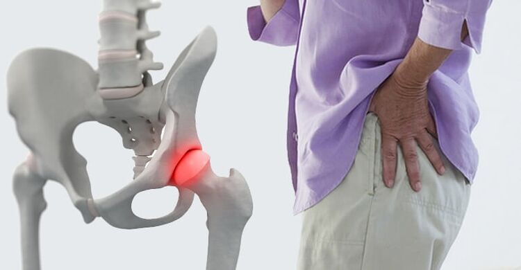 hip pain - a symptom of osteoarthritis of the hip