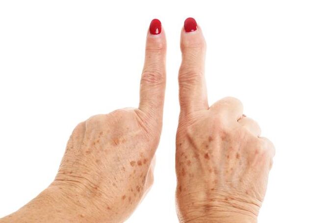 deforming arthrosis of the fingers