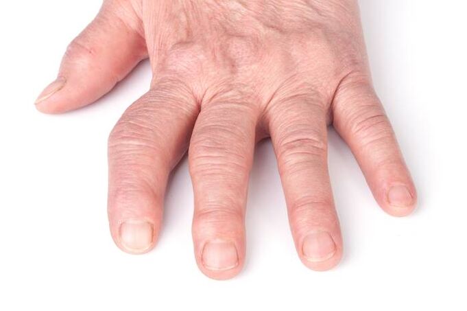 deforming arthrosis of the hands