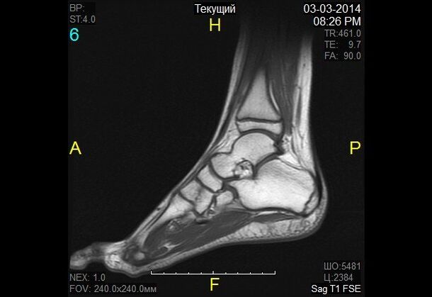 image of the ankle for osteoarthritis