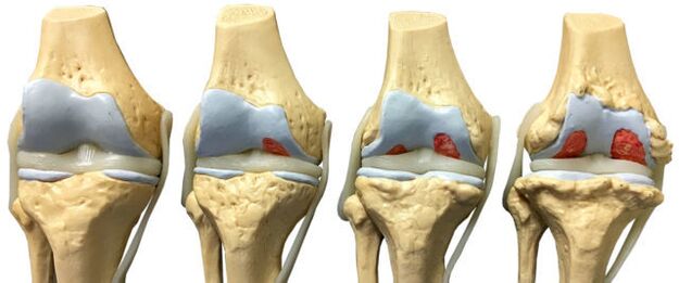 joint damage at different stages of the development of ankle osteoarthritis