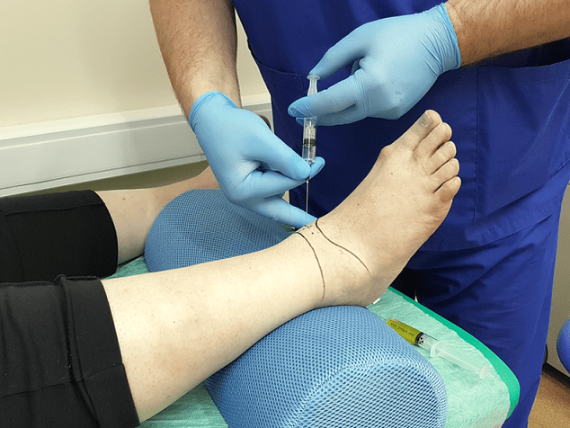 puncture for osteoarthritis of the ankle joint