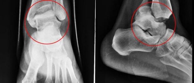 radiography for ankle osteoarthritis