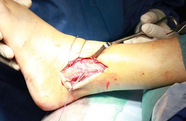 surgery for osteoarthritis of the ankle