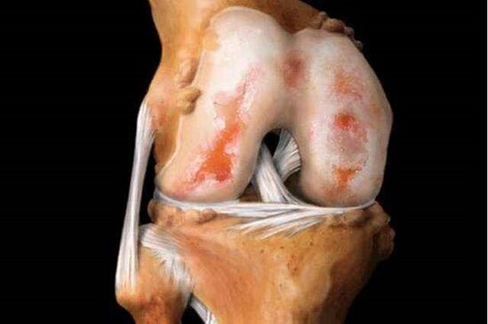 damage to the knee joint with osteoarthritis