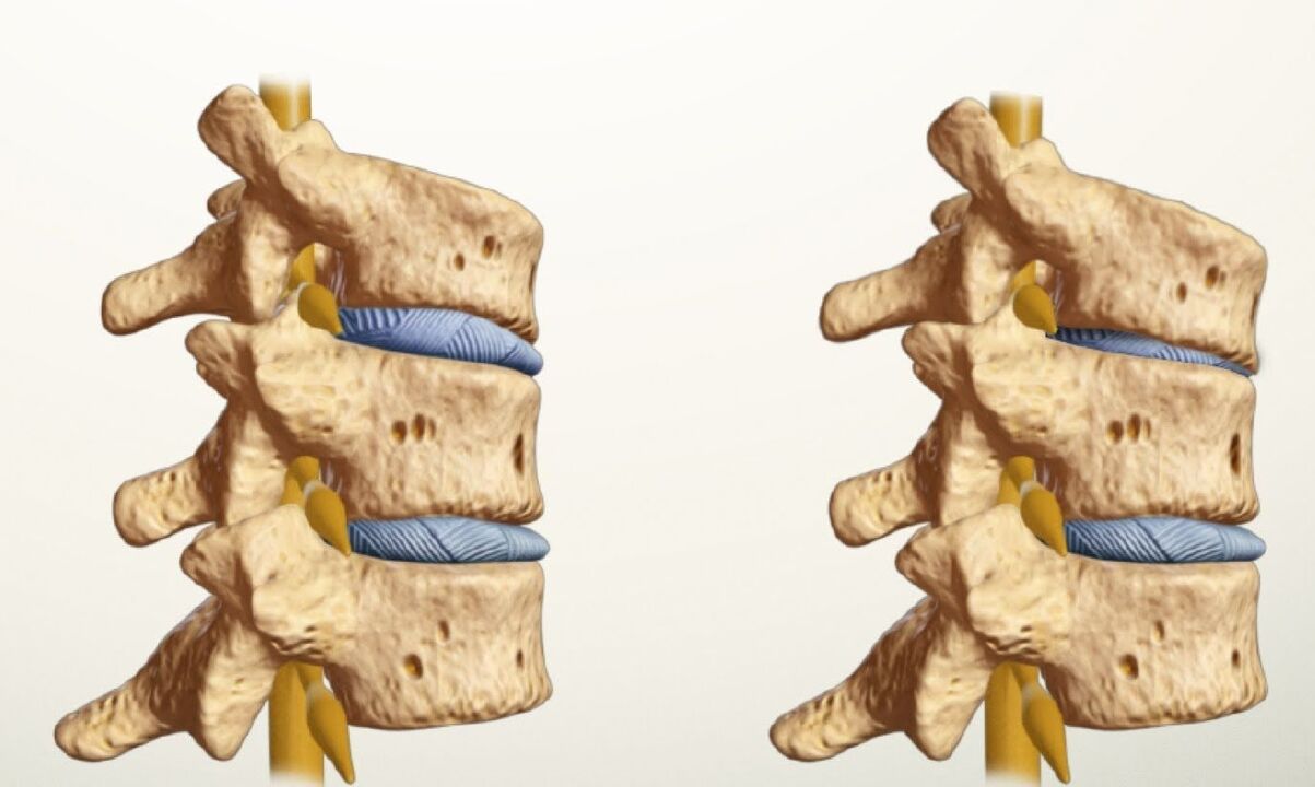 healthy and diseased spine with lumbar osteochondrosis