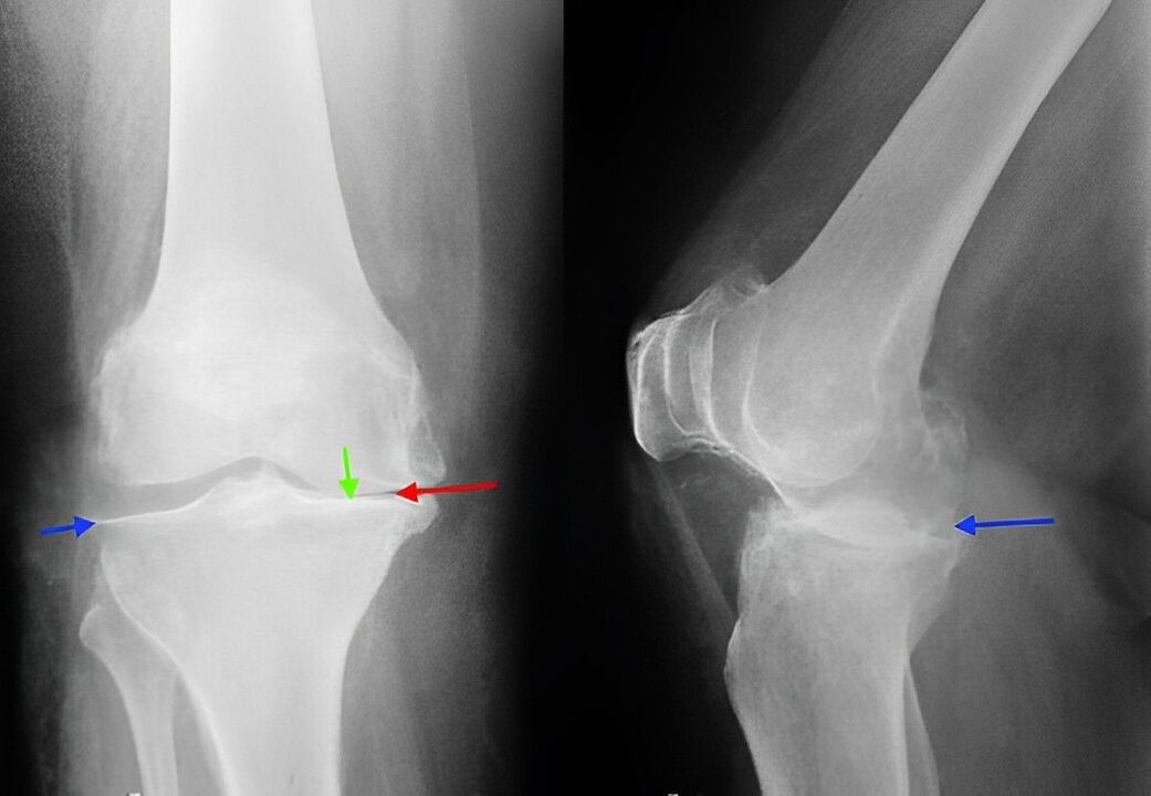 x-ray of knee osteoarthritis