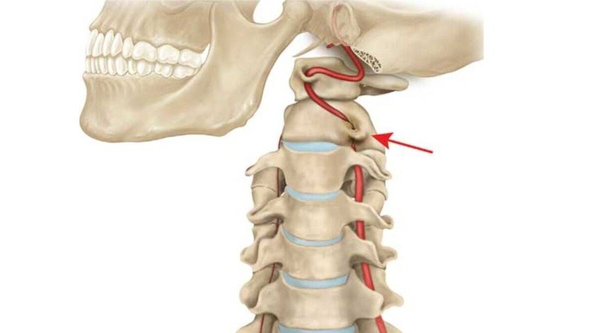 osteochondrosis of the cervical vertebrae