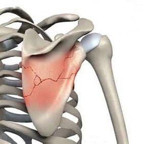 Fracture of the scapula is one of the causes of severe pain.