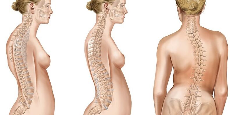 Scoliosis of the chest provokes pain in the shoulder blades