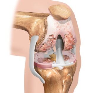 Cartilage wear and tear