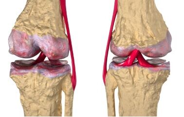 Varicose veins cause the development of gonarthrosis